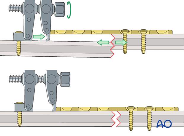 Distraction of a shaft fracture using an articulated tension device