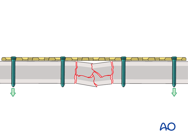 Bridge plating with locking head screws of a multifragmentary shaft fracture