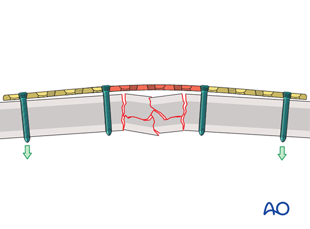 Bending stress on a bridge plate