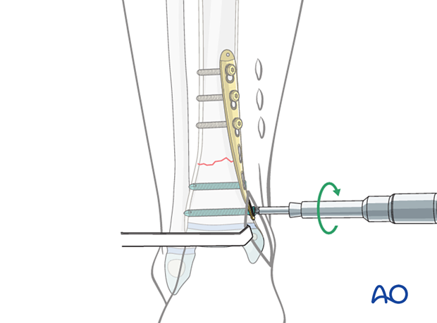 Minimally invasive plating (MIPO) of a simple fracture of the pediatric distal tibia