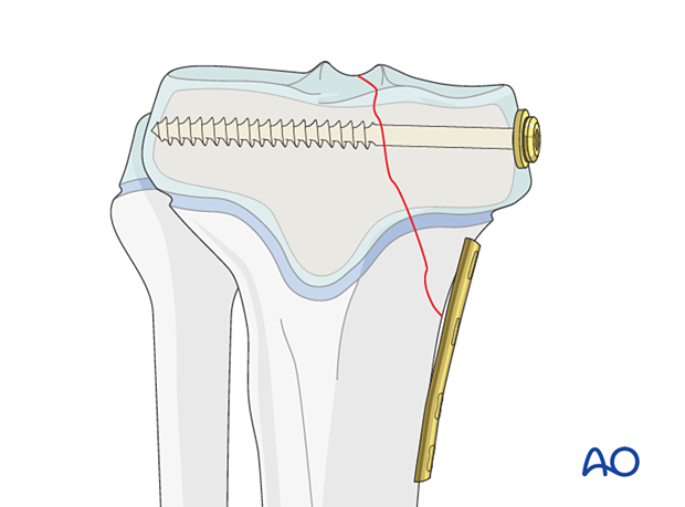 Plate contouring for butress plating of a partial articular fracture of the pediatric proximal tibia