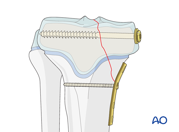 Butress plating of a partial articular fracture of the pediatric proximal tibia