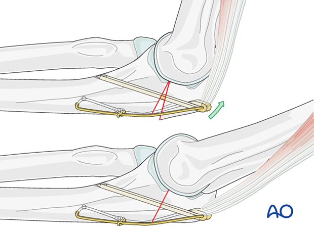 In some fractures eccentric loading on the tension side may vary. This may result in nonuniform compression or possible distraction on the tension side. 