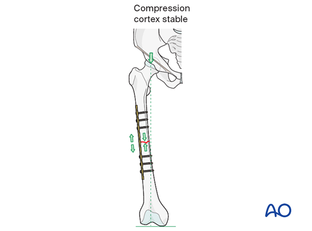 For a tension band to work the fracture site must be eccentrically loaded and the compression cortex must be stable.