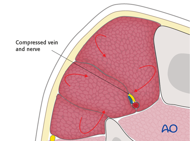 Compartment syndrome is a true surgical emergency. 