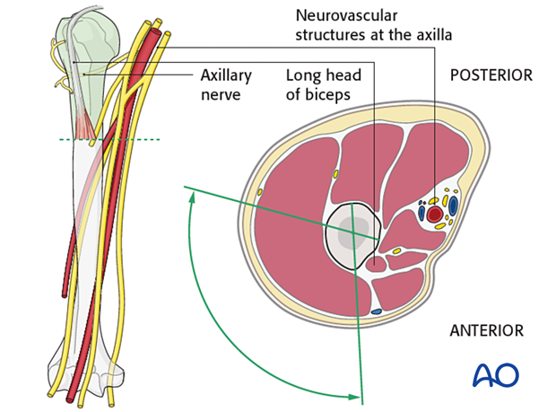 Pins are inserted from lateral (alternatively from an anterolateral or posterolateral) through the deltoid muscle.