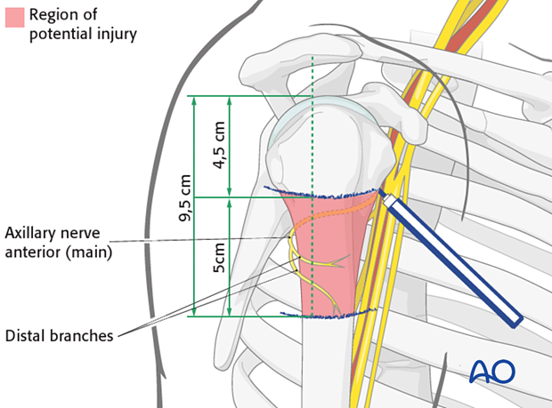 Before incising the skin, mark the distal limit of the approach,