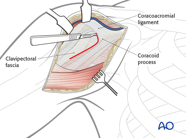 deltopectoral approach to the proximal humerus