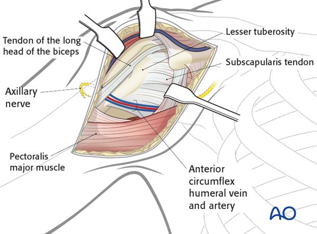 deltopectoral approach to the proximal humerus