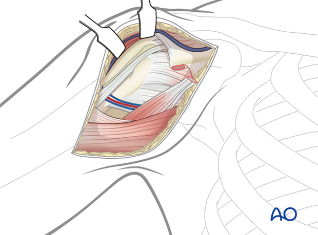 deltopectoral approach to the proximal humerus