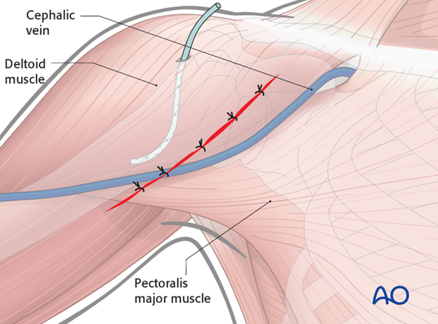 deltopectoral approach to the proximal humerus