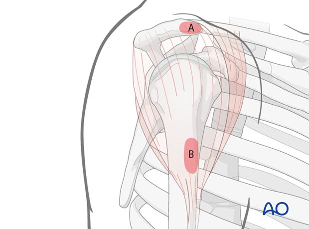 anterolateral approach