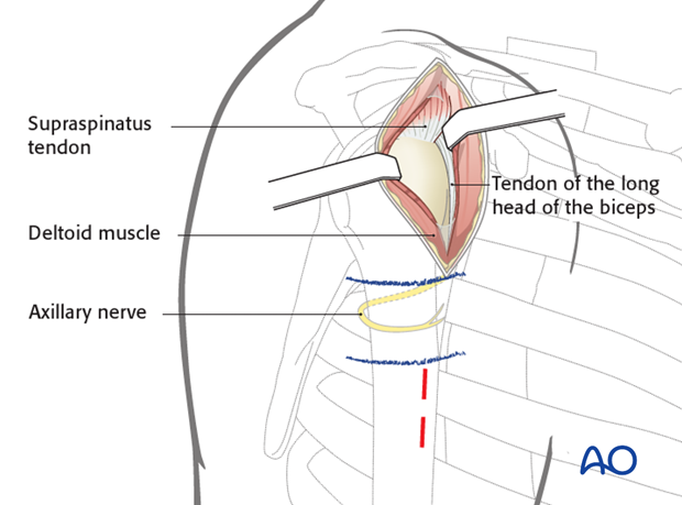 anterolateral approach