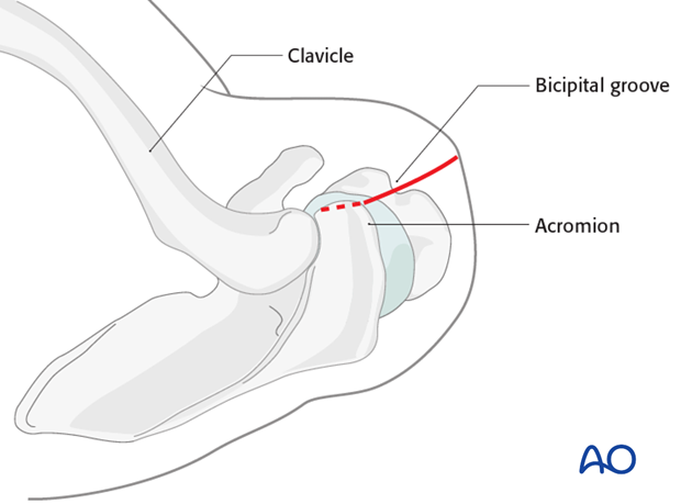 anterolateral approach