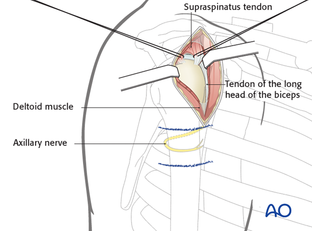 Anterolateral approach