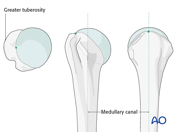 anterolateral approach