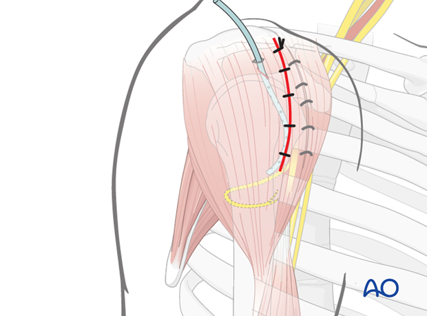 anterolateral approach