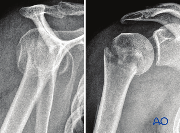 Clinical and radiographic assessment of patients with suspected proximal humeral fractures