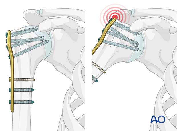 Pitfall: plate too proximal