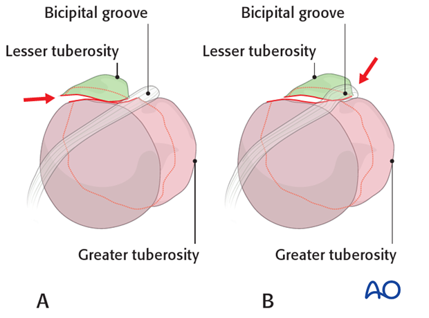 Proper reduction of the lesser tuberosity is often demanding.