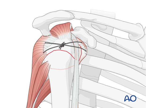 Sutures in the subscapularis tendon insertion aid both reduction and fixation of the lesser tuberosity. Once reduced, lesser ...