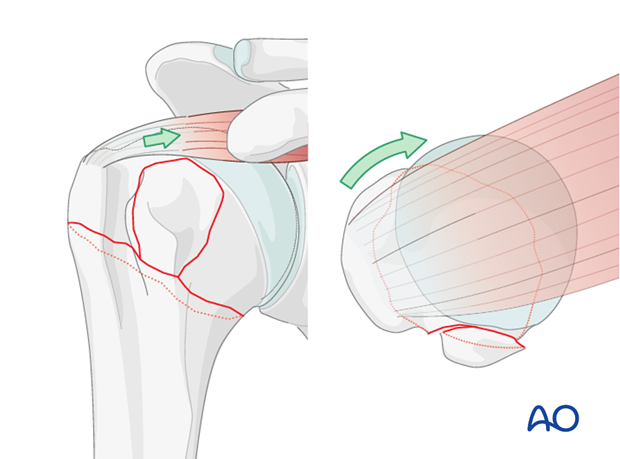 Proper reduction of humeral head segment