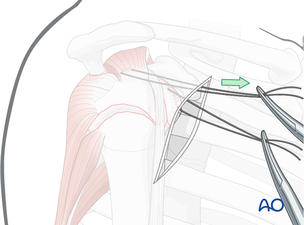 Anterior traction on the supraspinatus tendon helps expose the greater tuberosity and infraspinatus tendon.