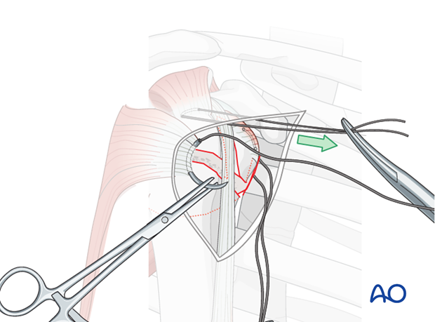 Insert a preliminary traction suture into the visible part of the posterior rotator cuff ...