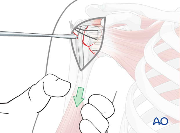 A periosteal elevator can be inserted into the fracture gap to disimpact the fracture.