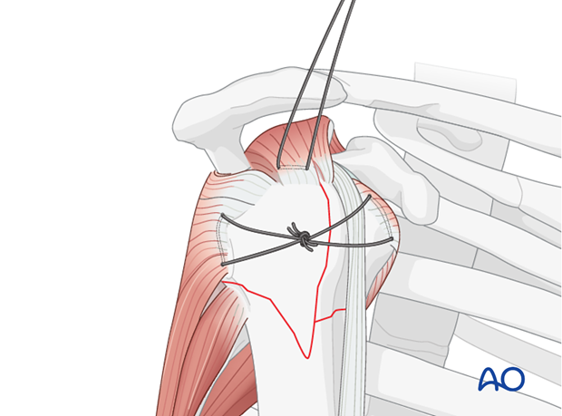 Placing and tensioning horizontal sutures helps reduce and stabilize the free tuberosity fragment. 