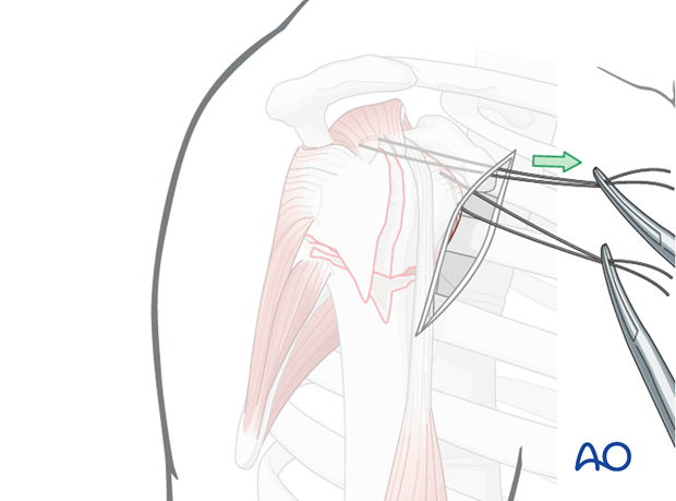 Anterior traction on the supraspinatus tendon helps expose the greater tuberosity and infraspinatus tendon.