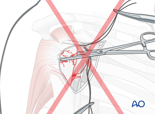 Grabbing bone fragments with a forceps or clamp will typically increase comminution of osteoporotic bone.