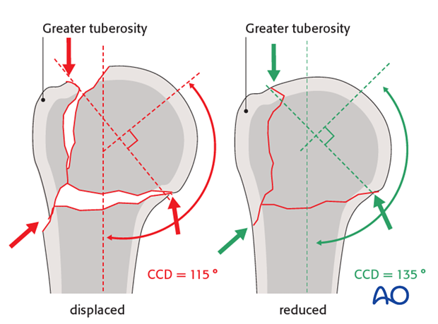 The greater tuberosity is typically displaced posterosuperiorly due to the pull of the rotator cuff.