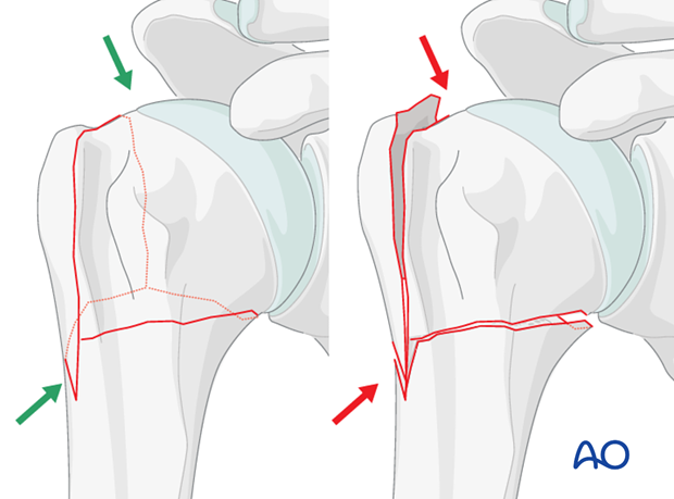 After preliminary fixation of the reduction confirm the result visually and by image intensification. 