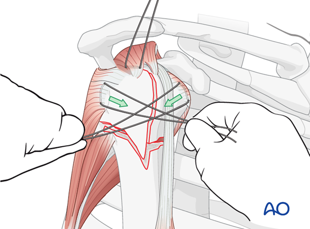 Reduce the involved tuberosity by pulling the sutures.