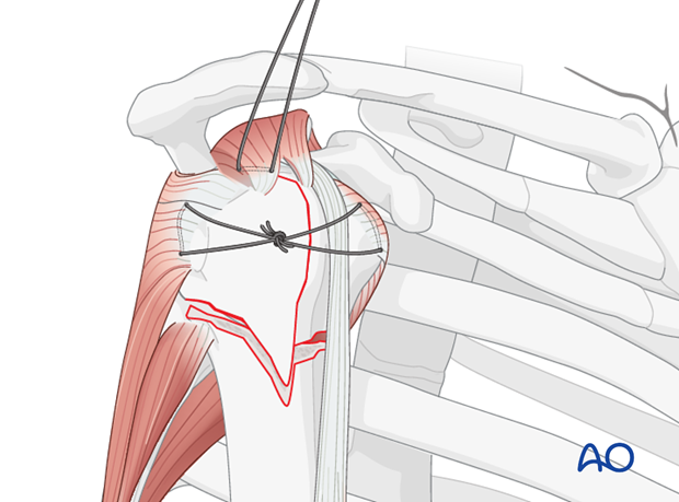 Tie a knot to stabilize the tuberosity to the head fragment. Thereby, the 3-part fracture is converted into a 2-part situation.