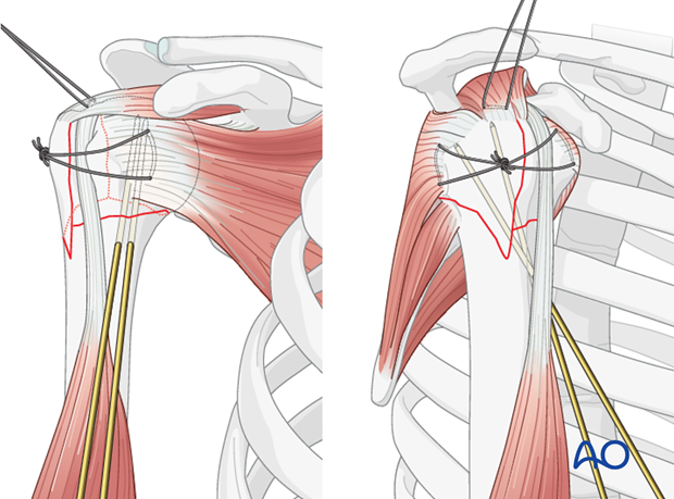 The fracture reduction is temporarily secured using 2 or 3 K-wires.