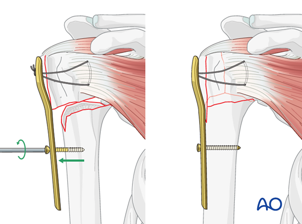 orif plate fixation