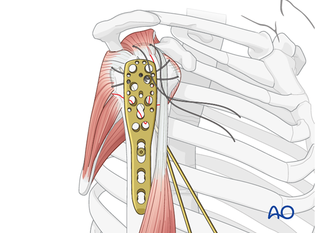 Attach the plate to the humeral shaft with a bicortical small fragment 3.5 mm screw inserted through the elongated hole. 