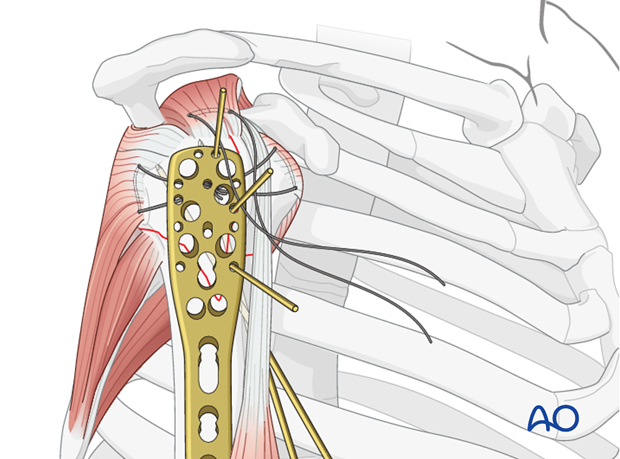 Pearl: preliminary plate fixation with K-wires