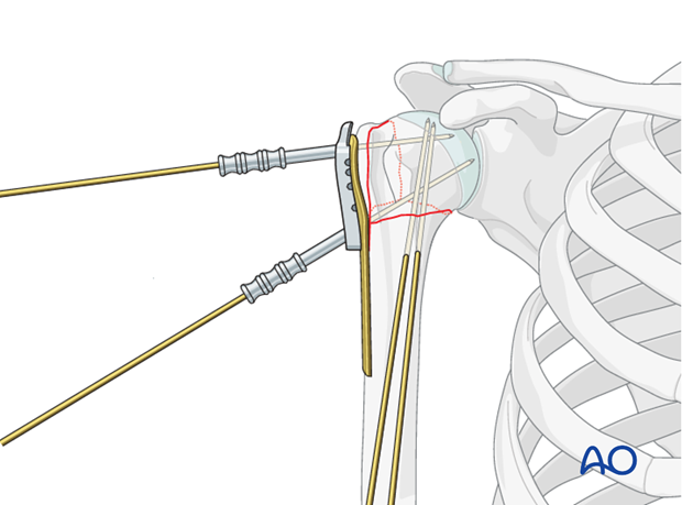 Alternative provisional plate fixation: K-wires inserted through their appropriate K-wire sleeves.