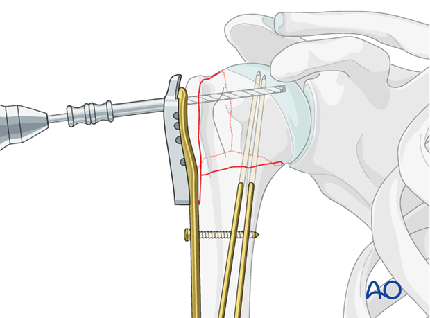 Use an appropriate sleeve to drill holes for the humeral head screws.