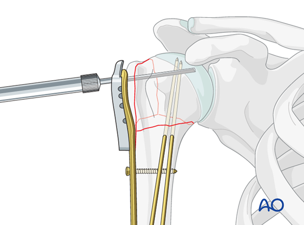 Determine screw length