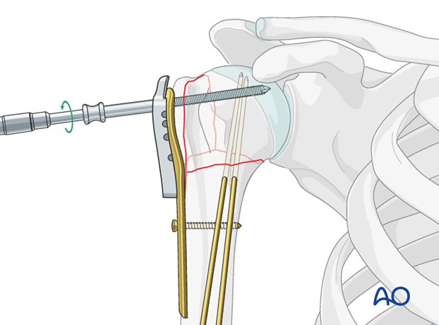 Insert a locking-head screw through the screw sleeve into the humeral head.