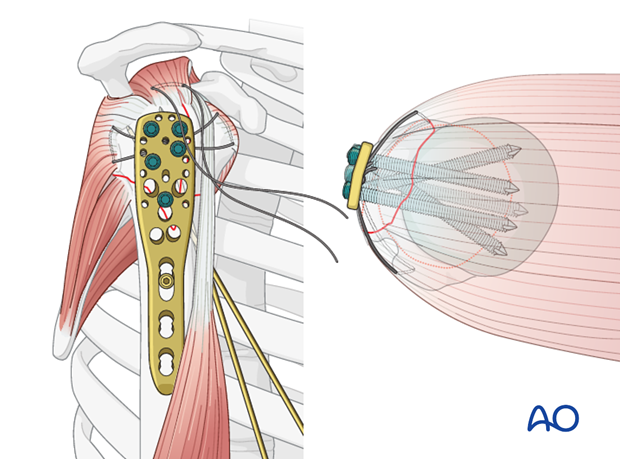 Place a sufficient number of screws (often 5) into the humeral head.