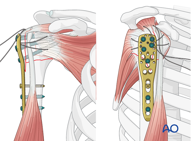 Insert one or two additional bicortical screws into the humeral shaft. 