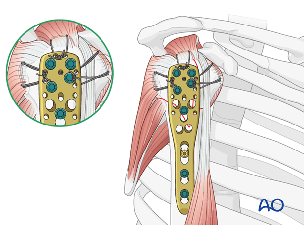 Sutures placed through the insertions of each rotator cuff tendon increase stability, and should be used.