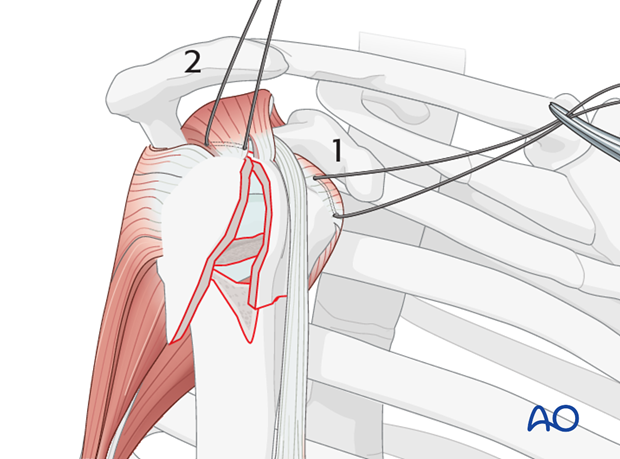 Hemiarthroplasty for 4-Part, dislocation, fragmentary metaphyseal ...