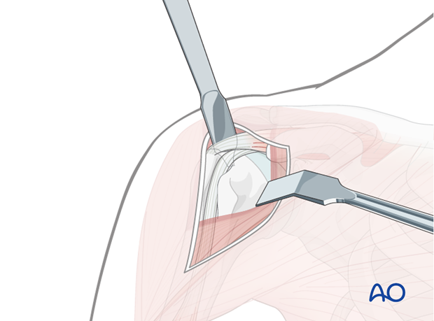 Use of blunt, curved Hohmann retractors underneath the deltoid muscle can be helpful to expose the humeral head.