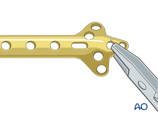 If no angular stable plate is available, a standard plate provides an alternative. The described procedure (reduction, ...